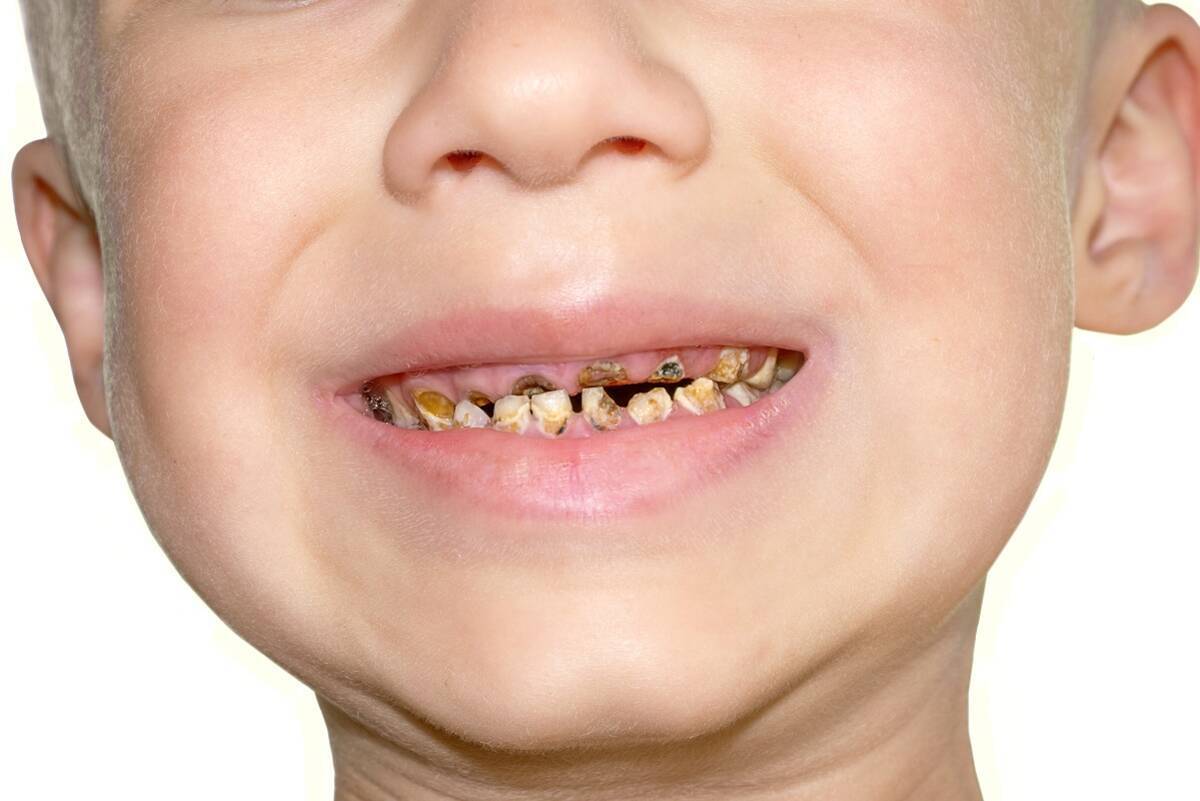 口腔崩壊の子供を目にした衝撃 歯科検診で虐待や育児放棄の発見も 19年6月12日 エキサイトニュース