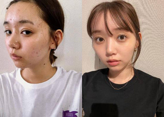 江野沢愛美がニキビに悩んだ過去を初告白 肌荒れ写真公開にも反響 21年5月29日 エキサイトニュース