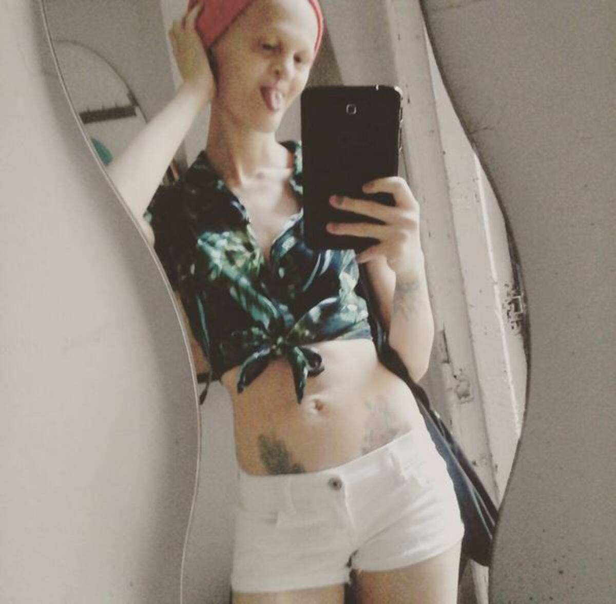 歯がなくても構わない 難病を抱えながら活躍するトップモデルに世界が注目 15年9月7日 エキサイトニュース