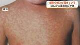 「はしか感染が全国で急増　富山県が予防接種の確認を呼びかけ」の画像1
