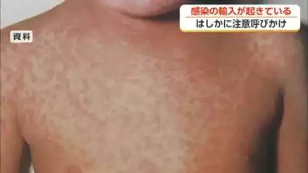 はしか感染が全国で急増　富山県が予防接種の確認を呼びかけ
