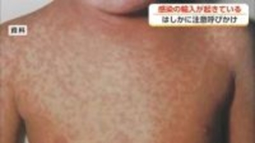 はしか感染が全国で急増　富山県が予防接種の確認を呼びかけ