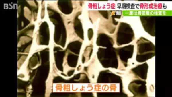 【骨粗しょう症予防】自分の骨密度を70歳前に知り「カルシウムとビタミンDの摂取を」