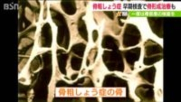 【にいがたケンジュプロジェクト】「自分の骨密度を70歳前に知りカルシウムとビタミンDの摂取を」　骨粗しょう症を予防するためには