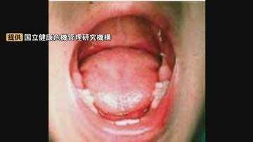 手足口病　島根県で全国一の流行…鳥取県でも流行拡大中「おもちゃをなめたりくわえたりすることがあるので、そういう消毒も毎日徹底している」エアコン欠かせない季節に新型コロナも…