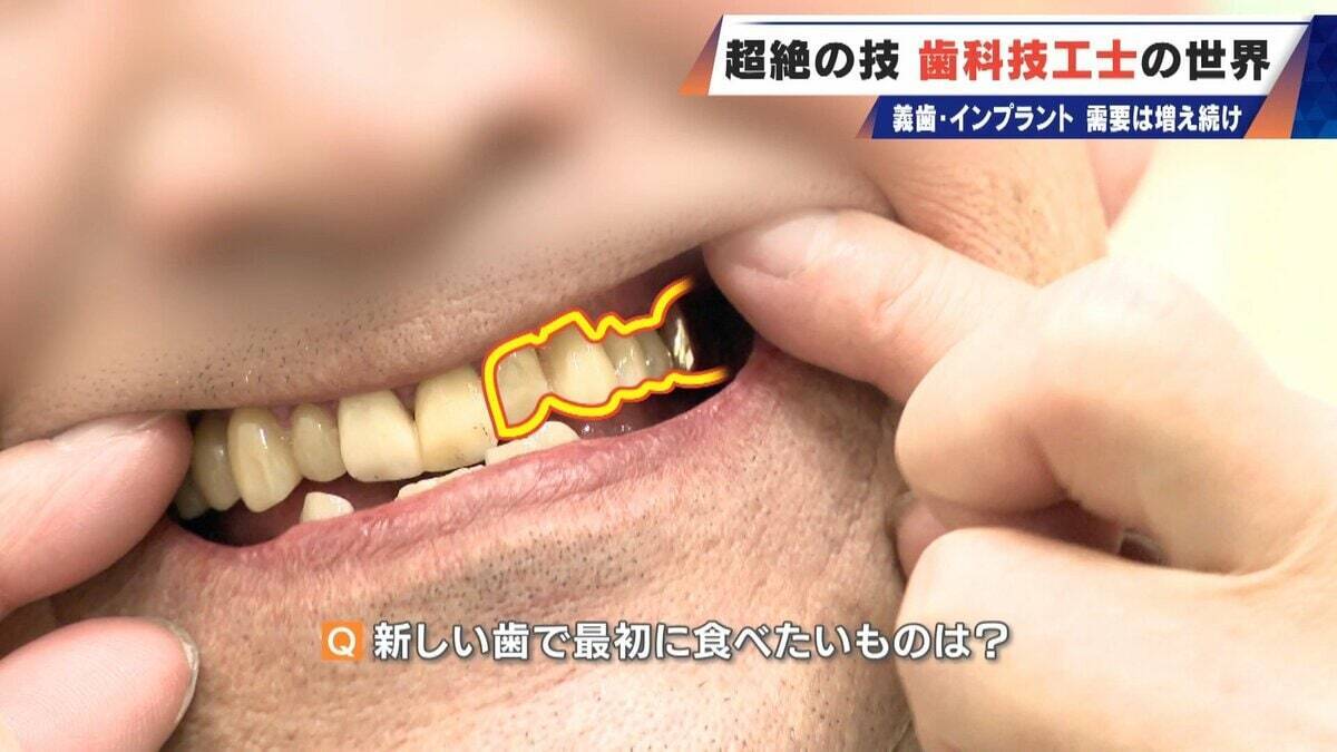 “入れ歯難民”に？減り続ける歯科技工士 現役の約半数が50歳以上 デジタル普及しても…かみ合わせはやっぱり“人間の手”