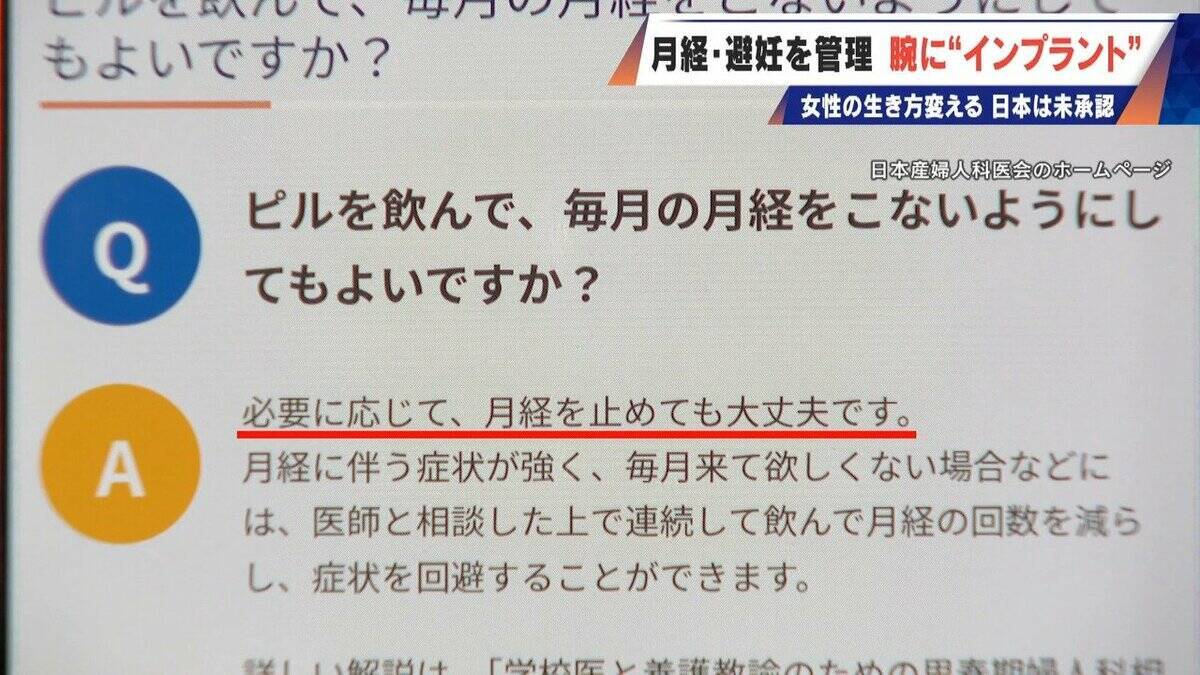 避妊･月経痛を軽減 腕に埋め込む4センチの“白い棒” 100か国以上で処方…しかし日本は未承認 ピルとは違う成分で血栓症のリスクが低い