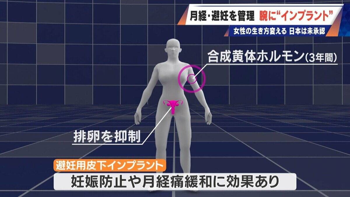 避妊･月経痛を軽減 腕に埋め込む4センチの“白い棒” 100か国以上で処方…しかし日本は未承認 ピルとは違う成分で血栓症のリスクが低い