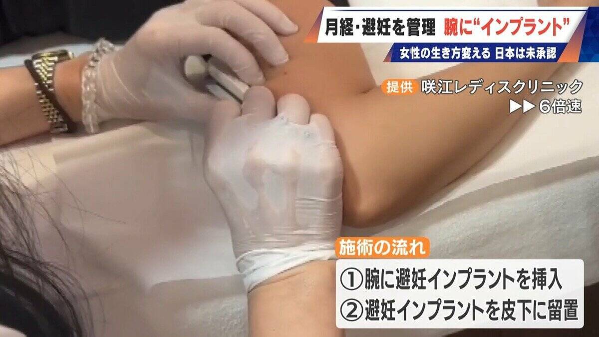 避妊･月経痛を軽減 腕に埋め込む4センチの“白い棒” 100か国以上で処方…しかし日本は未承認 ピルとは違う成分で血栓症のリスクが低い