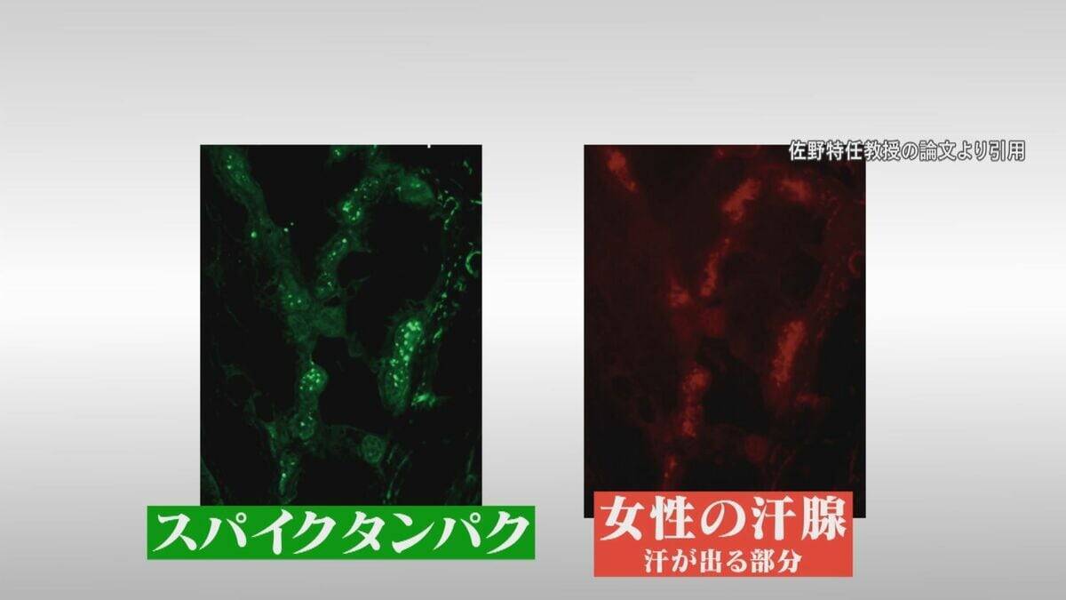 腕や足に赤い“水ぶくれの跡” 新型コロナワクチン接種後 皮膚に湿疹が…医師は患部にワクチン由来の“ある物質”を発見【“ワクチン後遺症”を考える シリーズ10】