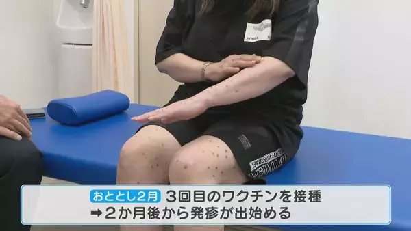 「腕や足に赤い“水ぶくれの跡” 新型コロナワクチン接種後 皮膚に湿疹が…医師は患部にワクチン由来の“ある物質”を発見【“ワクチン後遺症”を考える シリーズ10】」の画像