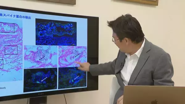 「腕や足に赤い“水ぶくれの跡” 新型コロナワクチン接種後 皮膚に湿疹が…医師は患部にワクチン由来の“ある物質”を発見【“ワクチン後遺症”を考える シリーズ10】」の画像