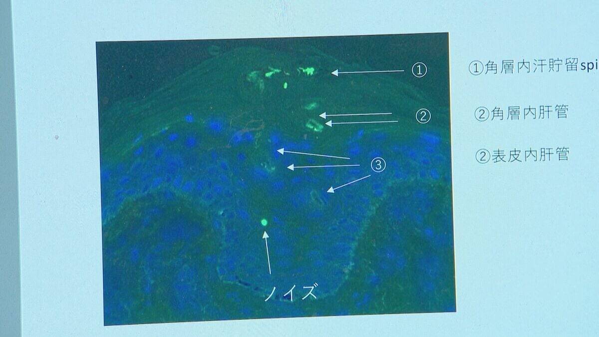 腕や足に赤い“水ぶくれの跡” 新型コロナワクチン接種後 皮膚に湿疹が…医師は患部にワクチン由来の“ある物質”を発見【“ワクチン後遺症”を考える シリーズ10】