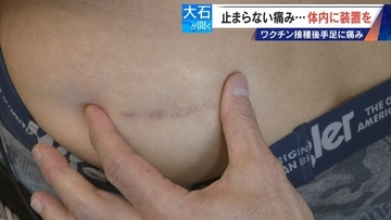 新型コロナワクチン接種後 全身に痛みが “体内に電流流す機械”埋め込み痛み緩和 国は救済申請を｢否認｣