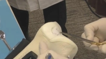 自分の細胞で培養の軟骨が膝の痛みを改善 変形性膝関節症に保険適用 3割負担で90万円に 患者は国内に推定1000万人  愛知･蒲郡市