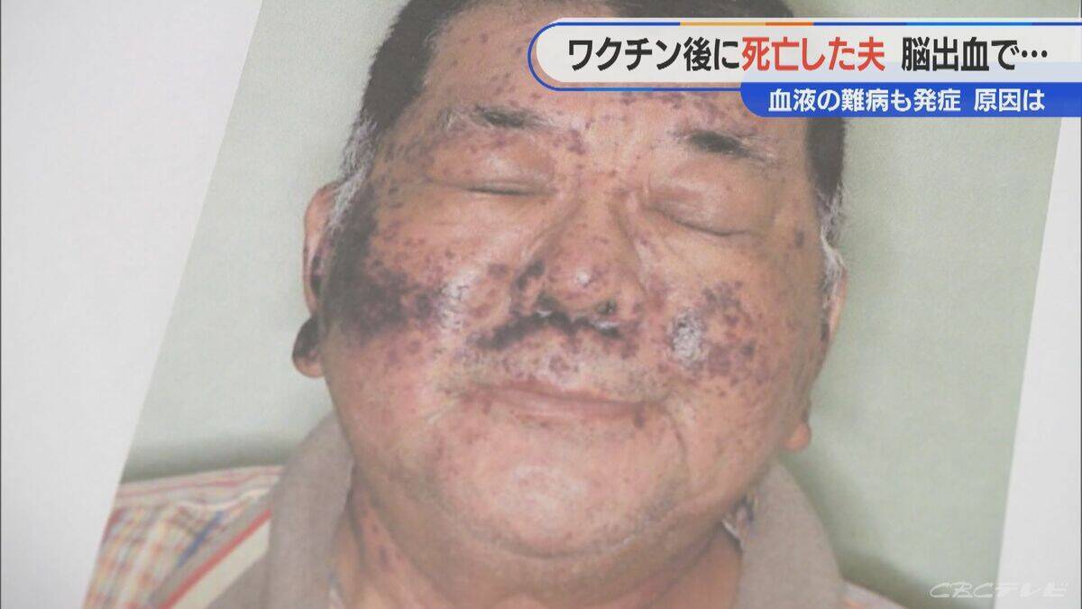 顔中に赤黒い内出血が… 手足も膨れ上がる 新型コロナワクチン接種後に夫が難病を発症し死亡 ｢検証されないと無駄死に」【“ワクチン後遺症”を考える シリーズ9】