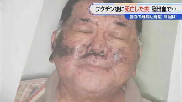 「顔中に赤黒い内出血が… 手足も膨れ上がる 新型コロナワクチン接種後に夫が難病を発症し死亡 ｢検証されないと無駄死に」【“ワクチン後遺症”を考える シリーズ9】」の画像