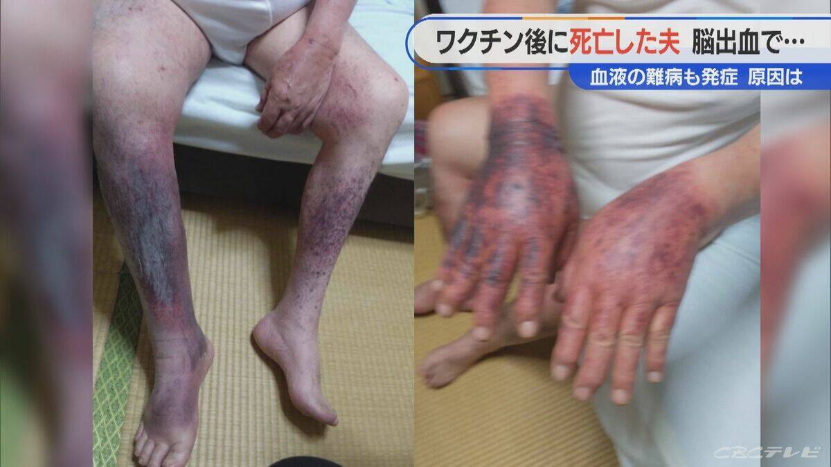 顔中に赤黒い内出血が… 手足も膨れ上がる 新型コロナワクチン接種後に夫が難病を発症し死亡 ｢検証されないと無駄死に」【“ワクチン後遺症”を考える シリーズ9】