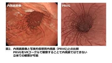 胃カメラやバリウムは不要　苦痛が少ない“胃がん検診”実現へ　胃の内部を3D画像で可視化する「バーチャル内視鏡検査法」名市大みどり市民病院などが開発