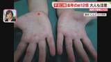 「手足口病　福岡で6週連続で警報レベル　大人も注意」の画像1