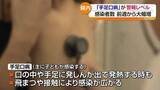 「手足口病　福島県内も警報レベルに」の画像1