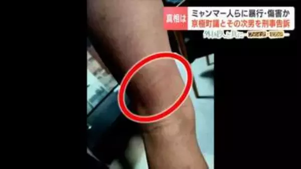 特定技能のミャンマー人らに暴行か 町議らを傷害容疑などで刑事告訴　20歳男性「怖かった、痛かった」町長は「できることは特にない」役場の不対応に懸念の声　北海道京極町