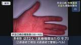 「手足口病は依然警報レベル」の画像1