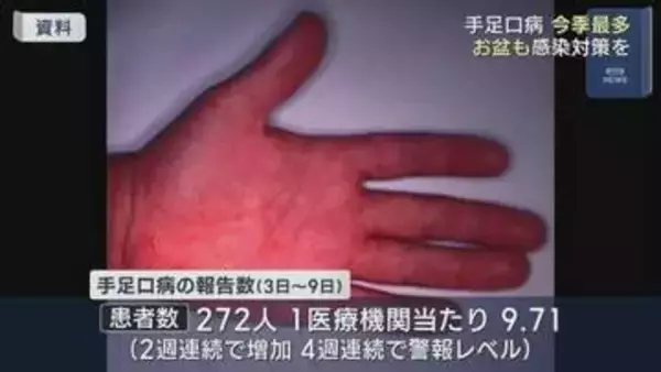 手足口病は依然警報レベル