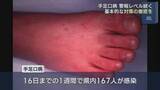 「手足口病の感染者、3週ぶりに減少も警報レベル続く」の画像1