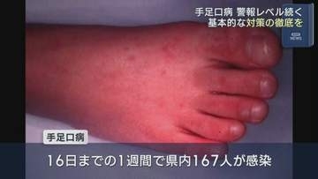 手足口病の感染者、3週ぶりに減少も警報レベル続く