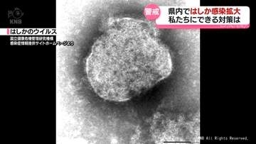 富山県内でもはしかの感染拡大　気を付けることは