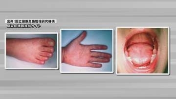 【山口】2年ぶりに手足口病の流行発生警報を発令　夏ごろにかけてピークとなる傾向
