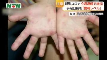 【注意】長崎県内で手足口病警報レベル継続　新型コロナも前週より感染報告数増加