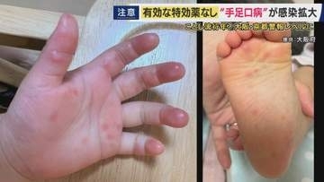 保育現場では感染拡大対策で「洗えない絵本やパズルは紫外線で殺菌」も　全国で「手足口病」が流行　大阪・京都でも警報レベルに　特効薬ない中で対策は「しっかり手洗い・タオルの共有を避ける」