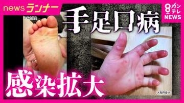 全国で「手足口病」が流行　大阪・京都でも警報レベルに　特効薬ない中での対策は「しっかり手洗い・タオルの共有を避ける」　保育現場では「紫外線で殺菌」など対策も