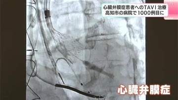「特に高齢者、高知県にぴったり」カテーテルを使った手術　心臓弁膜症の患者へのTAVI　高知市の病院で1000例目に