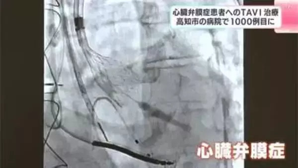 「特に高齢者、高知県にぴったり」カテーテルを使った手術　心臓弁膜症の患者へのTAVI　高知市の病院で1000例目に