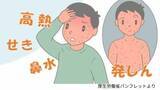 「「はしか」患者　県内で3人感染確認　鹿児島県が注意呼びかけ【はしかの注意点と予防方法】」の画像1