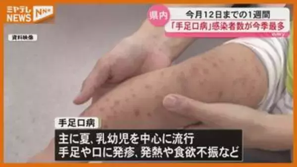 手足口病の感染者数が今シーズン最多に　宮城県内で2年ぶりの流行　こまめな手洗いなど呼びかけ