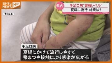 夏場に流行 手足口病“警報レベル”に  専門家に聞く対策は〈宮城〉