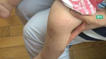 手足口病で石川県が２年ぶり「警報」 ２週連続の基準値超で大流行のおそれ