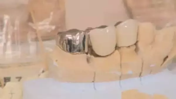 銀歯1本で5000円赤字？“金パラ”価格高騰に「チェックしないと怖い」歯医者でおきている異変とは