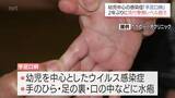 「幼児を中心とした感染症「手足口病」　宮崎県内で急増　2年ぶりに流行警報レベルを超える」の画像1