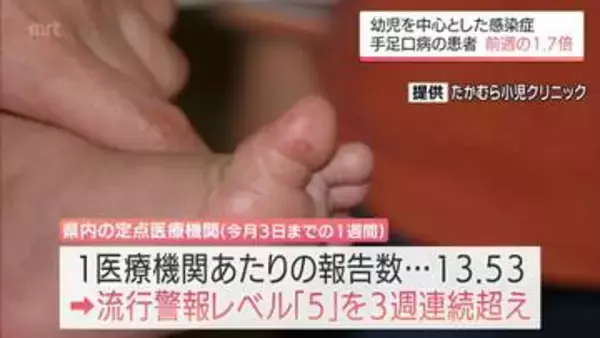 幼児を中心とした感染症「手足口病」　宮崎県内の患者数は前週比1.69倍　3週連続で流行警報レベル超