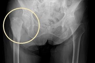 命にかかわる「ドミノ骨折」をどう防ぐ？ 原因は骨粗鬆症　専門家に聞く薬と食事・運動のポイント