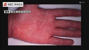 手足口病の患者数が警報レベル 長崎県内では2年ぶり　口内や手のひら、足裏などに水疱性の発疹できる感染症「乳幼児のおむつ交換後は手洗いを」