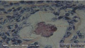 広島原爆の入市被爆者　70年後の体内からウラン検出　肺がん組織では「デスボール」確認　長崎大学研究グループ