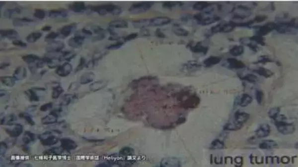 広島原爆の入市被爆者　70年後の体内からウラン検出　肺がん組織では「デスボール」確認　長崎大学研究グループ