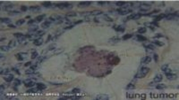 広島原爆の入市被爆者　70年後の体内からウラン検出　肺がん組織では「デスボール」確認　長崎大学研究グループ