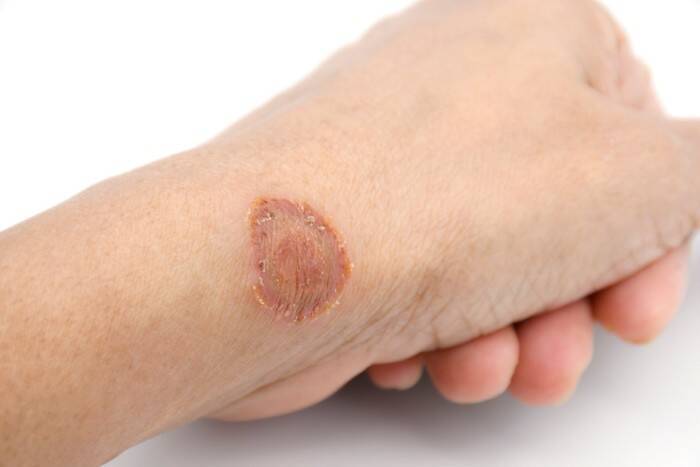 猫にカビが生えてしまう『皮膚糸状菌症』とは？主な原因や症状、人への感染リスクまで解説